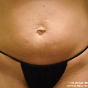 Tummy Tuck before and after photos