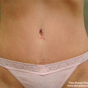 Tummy Tuck before and after photos