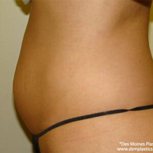 Tummy Tuck before and after photos