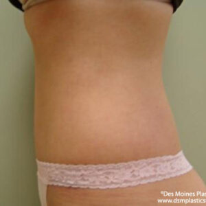 Tummy Tuck before and after photos