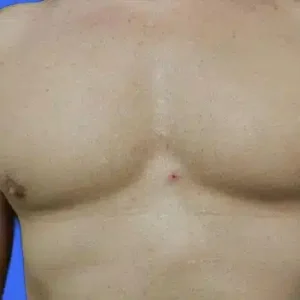 CoolSculpting before and after photos CoolSculpting before and after photos