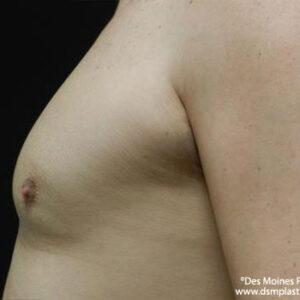 CoolSculpting before and after photos