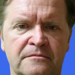 Brow Lift before and after photos