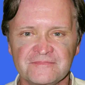 Brow Lift before and after photos