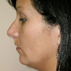 Neck Liposuction before and after photos