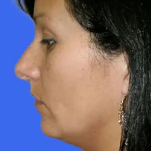 Neck Liposuction before and after photos