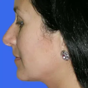 Neck Liposuction before and after photos