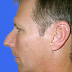 Chin Augmentation before and after photos