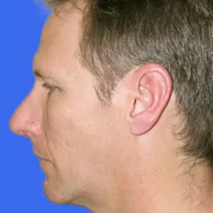 Chin Augmentation before and after photos