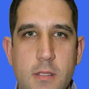 Ear Surgery before and after photos