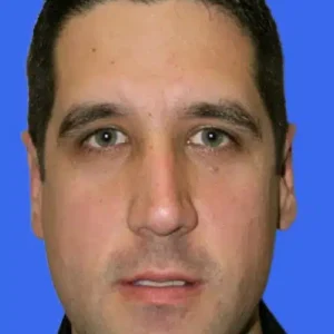 Ear Surgery before and after photos