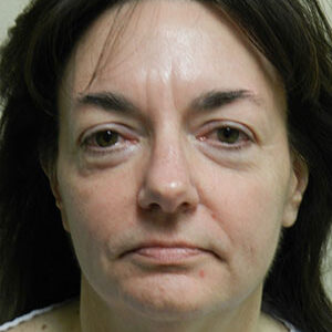 Face Lift before and after photos