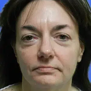 Face Lift before and after photos