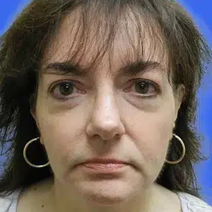 Face Lift before and after photos