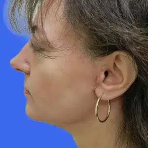 Face Lift before and after photos