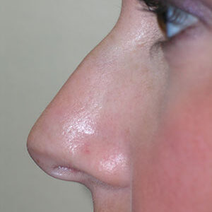 Rhinoplasty before and after photos