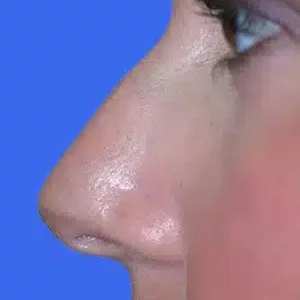 Rhinoplasty before and after photos