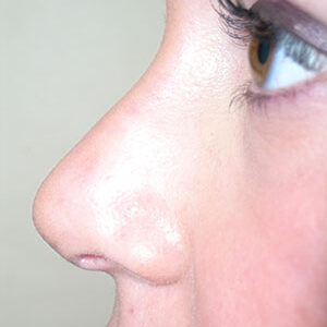 Rhinoplasty before and after photos