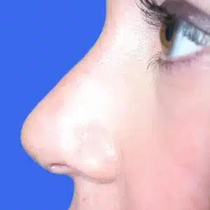 Rhinoplasty before and after photos