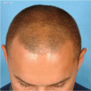 Neograft Hair Loss Replacement before and after photos