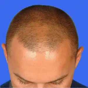 Neograft Hair Loss Replacement before and after photos