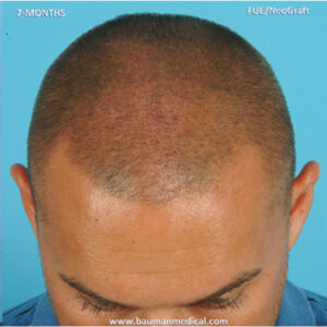 Neograft Hair Loss Replacement before and after photos