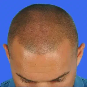 Neograft Hair Loss Replacement before and after photos