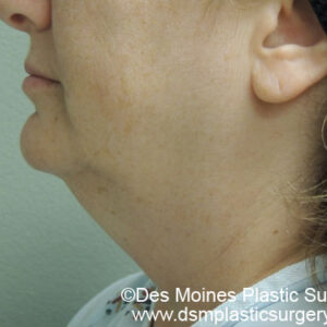 Laser Lift before and after photos
