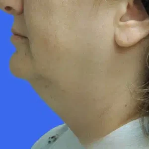 Laser Lift before and after photos