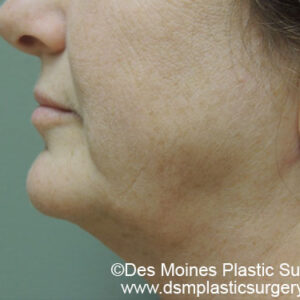 Laser Lift before and after photos