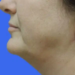 Laser Lift before and after photos