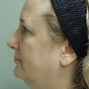 Laser Lift before and after photos