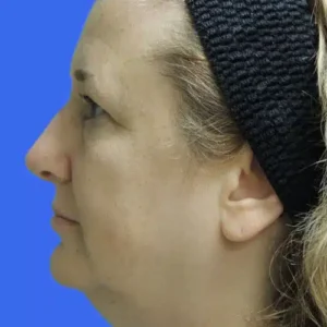 Laser Lift before and after photos