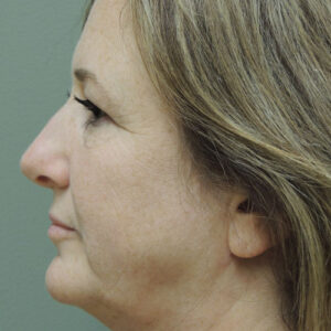Laser Lift before and after photos