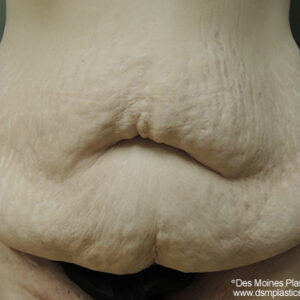 Tummy Tuck before and after photos