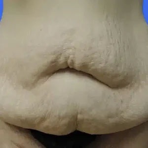 Tummy Tuck before and after photos Tummy Tuck before and after photos