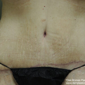 Tummy Tuck before and after photos