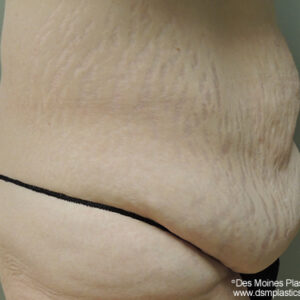 Tummy Tuck before and after photos