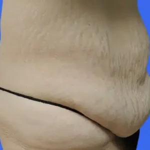 Tummy Tuck before and after photos Tummy Tuck before and after photos