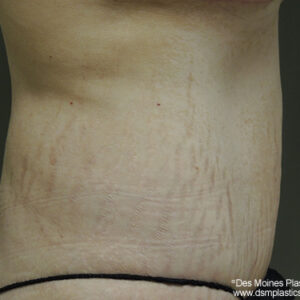 Tummy Tuck before and after photos