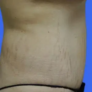 Tummy Tuck before and after photos Tummy Tuck before and after photos