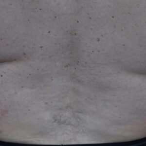 Liposuction before and after photos