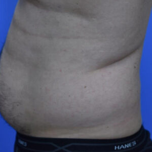 Liposuction before and after photos