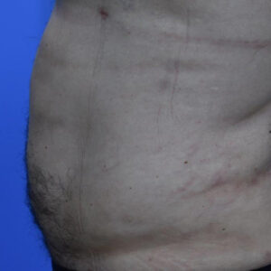 Liposuction before and after photos