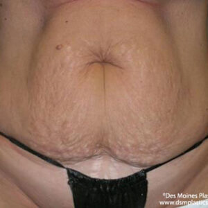 Tummy Tuck before and after photos