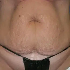 Tummy Tuck before and after photos Tummy Tuck before and after photos