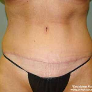 Tummy Tuck before and after photos