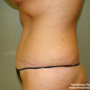 Tummy Tuck before and after photos