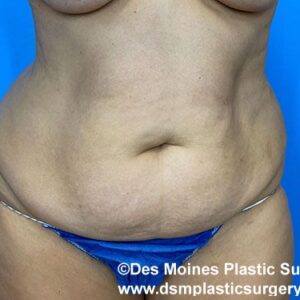 Tummy Tuck before and after photos