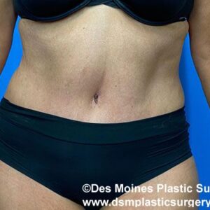 Tummy Tuck before and after photos